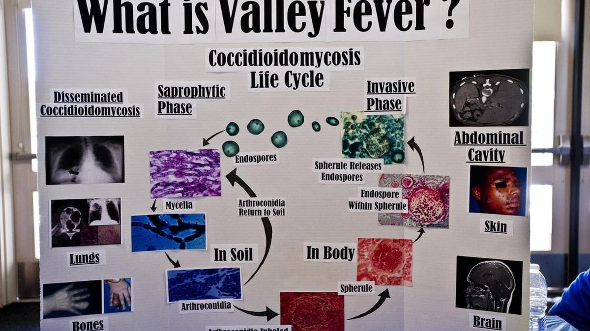 Information about valley fever is displayed during Valley Fever Awareness Day on the University of California, Merced campus, Tuesday, (09-16-14). Valley fever is a fungal infection that can affect the body after inhaling coccidioides organisms.